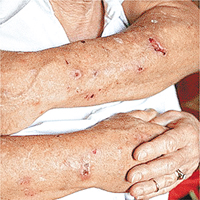 莫吉隆斯症患者會感到皮膚下像有寄生蟲蠕動。	資料圖片