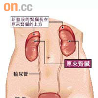 重複腎位置 示意圖