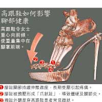 首張腳部立體掃描圖顯示 穿高跟鞋會致關節炎