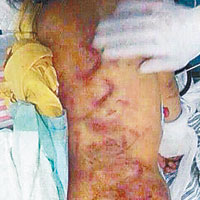 惠州五歲女童遭虐打周身傷