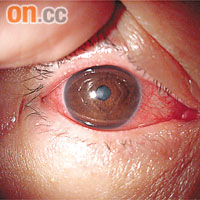 偽膜紅眼症患者的眼球表面，出現一層黏膜。