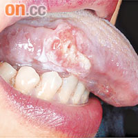 舌頭持續潰瘍或有像「飛滋」的硬塊，均可能是舌癌徵狀。