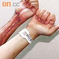 子軒的左手受克雷伯士氏桿菌感染，需即時切除壞死組織。