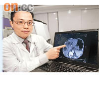 樂家豪表示，在電腦掃描影像下，可見肝囊腫病人的肝臟右上方有黑色陰影。