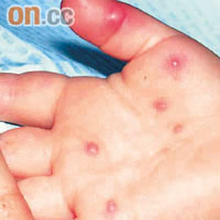 感染ＥＶ７１腸病毒，輕則手腳出疹，嚴重可致死。