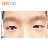 ◆眼敏感捽眼會令周邊眼皮變厚。