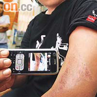 Eva的手機儲存了當時手臂傷勢的照片，而現在手臂還留下疤痕。