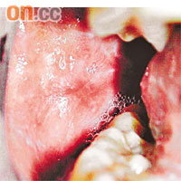 口腔扁平苔癬分非糜爛型和糜爛型，後者口腔呈紅色糜爛，會敏感疼痛。