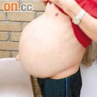 呂先生患肝臟多囊症，腹部積水如婦女懷孕。