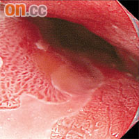 巴洛氏食道症患者照胃鏡，多數會發現胃壁出奇地紅。