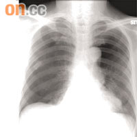 五十一歲男病人兩邊肺均有漏氣迹象。《香港急症醫學期刊》圖片