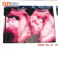 鄭小姐照超聲波檢查時，胎兒身體非常健康。	（受訪者提供）