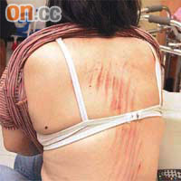 受傷女兒背部傷痕纍纍。