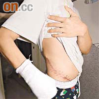 梁廣文展示傷殘的右手和取皮留下逾呎長的傷疤。