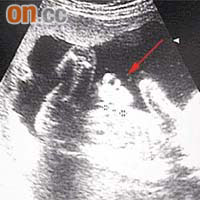 超聲波影像顯示胎兒腹裂，腸臟凸出（箭嘴示）。