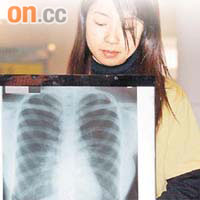 市民可透過肺部X光檢查，了解有否感染肺癆。	資料圖片