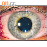 病人的眼睛被狼蛛毛刺傷，出現發炎徵狀。