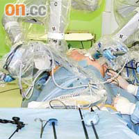 一名三十歲女病人於上年十月成功接受全港首宗機械臂微創手術。