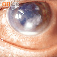 圖為感染綠膿桿菌的眼睛。