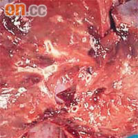 健康肺組織像濕潤海綿，纖維化的肺部呈蜂窩狀。