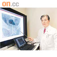 羅光彥表示，植入放射性粒子治前列腺癌，可避免失禁或不舉等副作用。
