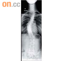 脊柱側彎患者的脊骨彎曲，X光顯示患者脊骨呈「S」形。