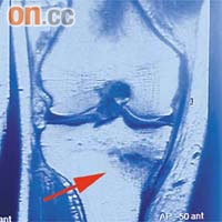 磁力共振圖片顯示陳先生的膝關節內側有壓力性骨折（箭嘴示）。