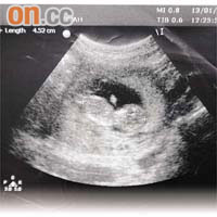 林太今年一月十三日照超聲波，赫然發現胎兒已有4.52厘米長。