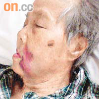 麥燕萍照胃鏡後，面部變得腫脹，更出現嚴重瘀痕。相片由受訪者提供