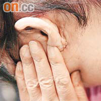 張女士接受微創腮腺瘤切除手術後，疤痕隱藏於耳背。