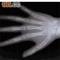 從較年幼矯齒者的手部X光片及頭頸X光片可見，手指關節間仍有較多空隙，脊椎骨之間亦未填滿。