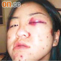 在澳洲珀斯被毆的姓楊女子左眼瘀腫。	讀者提供圖片