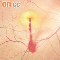 有維修技工被激光傷及視網膜上的黃斑點，喪失九成視力。