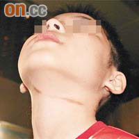 男童頸部留下三條約七吋長紅痕。