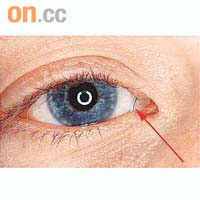 微創手術利用內窺鏡經鼻腔切開淚囊後，再將矽膠小管經眼角淚點穿入鼻腔，形成新淚管（箭嘴示）。