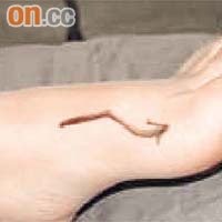 患拇趾嵌甲病人需在腳趾中央開刀做手術，但醫生錯誤在拇趾側開刀。	資料圖片