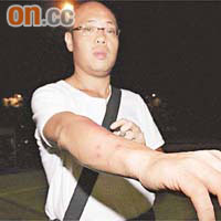 劉先生展示被夾致紅腫的手臂。