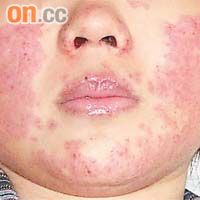 皮膚出紅疹是紅斑狼瘡的常見徵狀。