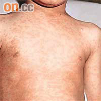 部分出現過敏的兒童發病時會出風疹。	資料圖片