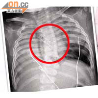 茵茵的手術順利進行，院方成功在其肺支氣管內置入支架（紅圈示）。	圖片由榮總兒童醫學中心提供