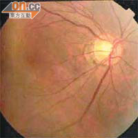 青光眼屬慢性視神經退化，多影響周邊視力。