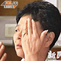 其中一名受害人王阿姨眼睛出現不良反應。	（互聯網圖片）