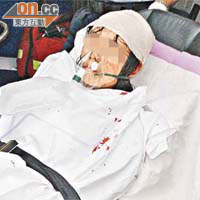 鄧女被扑爆後腦重傷昏迷。