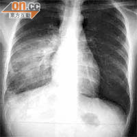 女病人入院後肺炎愈來愈嚴重，右邊肺部「花晒」。  《European Respiratory Journal》圖片