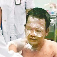 桂醫生遭病人潑汽油燒傷恐毀容